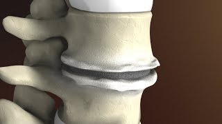 Degenerative Disc Disease Spondylosis explained by Spine Surgeon Dr Jessica Shellock Plano TX [upl. by Ostap]