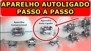 Aparelho Autoligado  Como funciona PASSO A PASSO RESUMIDO [upl. by Divaj]