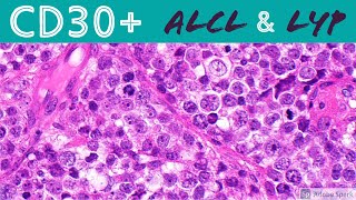 Anaplastic Large Cell Lymphoma amp Lymphomatoid Papulosis CD30 Positive Lymphoproliferative Disorders [upl. by Alioz]