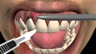 How to treat a tooth abscess [upl. by Aloel]