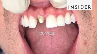 How Dentists Create Tooth Veneers And Crowns [upl. by Vadnee]