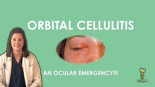 Orbital Cellulitis an ocular emergency [upl. by Johny963]