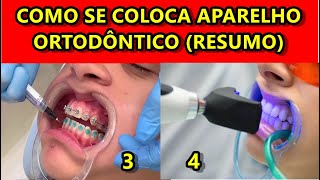 Como Colocar Aparelho Dentário  Passo a Passo resumido [upl. by Aropizt580]