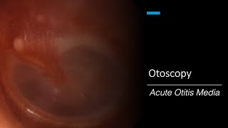 Acute Otitis Media Otoscopy [upl. by Buroker]