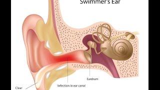 Otitis Externa [upl. by Blakely]