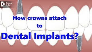 How crowns attach to Dental Implants  Dr Manesh Chandra Sharma [upl. by Hutner]