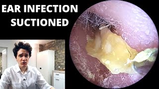 Pus and Dead Skin Suctioned From Ear Canal Acute Otitis Externa [upl. by Airlie]