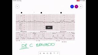 CARDIOTOCOGRAPHY  CTG INTERPRETATION [upl. by Yong]