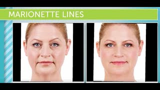 Treating Marionette Lines At Hermann Wellness [upl. by Notirb]