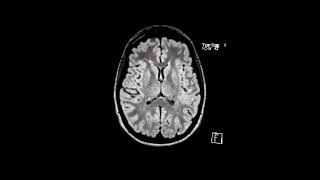 MS white matter lesions  First Look MRI [upl. by Annairba]