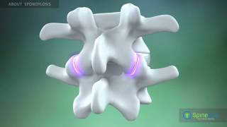 Spondylosis About [upl. by Werby]