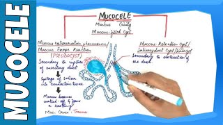 Sphenoid Sinus Mucous Retention Cyst vs Mucocele [upl. by Orvil]