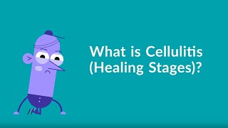 Cellulitis Healing Stages [upl. by Melesa284]