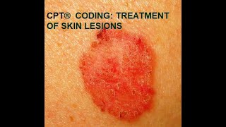 CPT® coding for Skin Lesions [upl. by Tengdin]