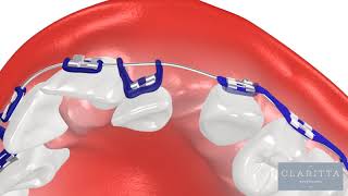 Oque é Ortodontia Como funciona um Aparelho Ortodôntico ortodontia invisalign clinicajin [upl. by Naltiak]