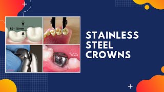 PEDIATRIC DENTISTRY  STAINLESS STEEL CROWNS [upl. by Jordanna]