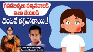 గవదబిళ్ళలు పోవాలంటే  How to Cure Mumps in Telugu  Mumps in Children  Treatment Range Hospital [upl. by Rubens]