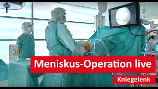 Kniegelenk MeniskusOperation live [upl. by Arocahs]