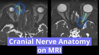 Cranial Nerve Anatomy on MRI [upl. by Canica]