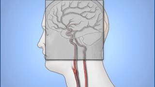 Vertebral Artery Test [upl. by Jacinta]