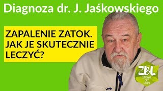 dr Jerzy Jaśkowski  Leczenie zapalenia zatok [upl. by Reuven]