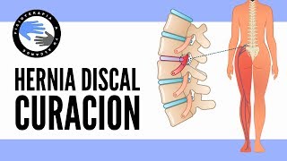 HERNIA DISCAL CERVICAL  Ejercicios para aliviar fortalecer y mejorar [upl. by Dalila109]