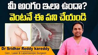 Best Treatment for Phimosis in Telugu  KSR Stapler Circumcision  Treatment Range Hospital [upl. by Novelc]