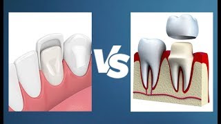 Veneers vs Crowns  Whats the Difference [upl. by Alain]