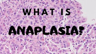 What is Anaplasia  Pathology mini tutorial [upl. by Haimirej]