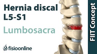 5 EJERCICIOS para HERNIA de DISCO LUMBAR o HERNIA DISCAL  Fisioterapia  Fisiolution [upl. by Upali]