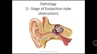 Acute Otitis Media 1 [upl. by Revart450]