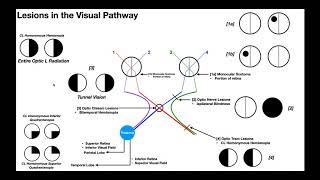 Lesions to the Visual Pathway EXPLAINED [upl. by Nalrah]