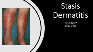 Exosomes Webinar 10  Stasis Dermatitis [upl. by Missie]