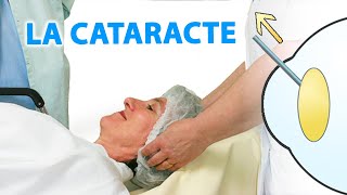 QUestce que la cataracte et comment la traiter [upl. by Ivanna]