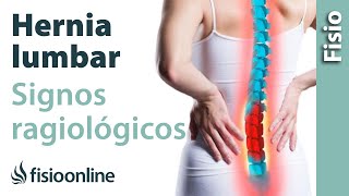 Hernia discal lumbar y protrusión discal  Signos radiológicos [upl. by Helge]