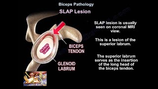 SLAP Lesion  Everything You Need To Know  Dr Nabil Ebraheim [upl. by Iruy]