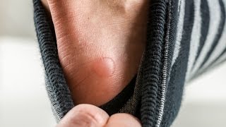 The Basics Should You Pop a Blister [upl. by Rafi642]