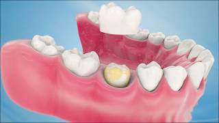 Dental Crown Procedure [upl. by Mccandless940]