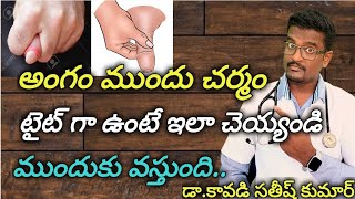 Phimosis TreatmentTight Forskin Solution in Telugu  Doctor Satheesh  Yes1TV [upl. by Eugine]