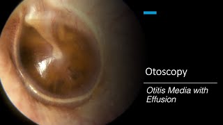 Otitis Media with Effusion Otoscopy [upl. by Aidile115]