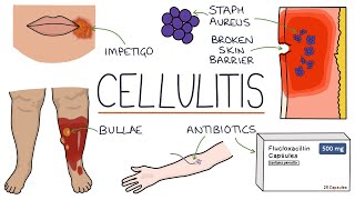 Understanding Cellulitis Skin and Soft Tissue Infections [upl. by Nahtanha]