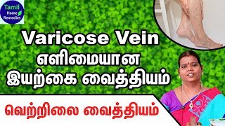 Varicose Veins Treatment in Tamil  Varicose Veins Siddha Treatment  Varicose Veins Home Remedies [upl. by Ark]