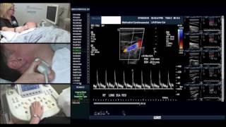 Modified Vertebral Artery Test [upl. by Avlasor]