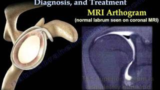 SLAP Tear Symptoms Diagnosis And Treatment  Everything You Need To Know  Dr Nabil Ebraheim [upl. by Bernt]