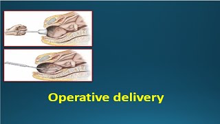 OPERATIVE DELIVERY  Instrumental deliveries Vacuum amp Forceps [upl. by Heida]