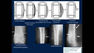 Bone Lesions Radiographic Assessment Part 1 by Geoffrey Riley MD [upl. by Cutlip]