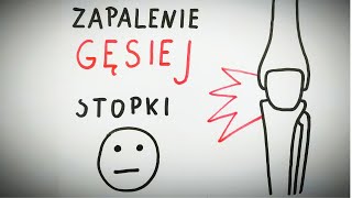 BÓL KOLANA Zapalenie gęsiej stopki [upl. by Parrisch744]