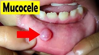 Before and After Photos of Mucocele Treatment of Lower Lip [upl. by Ylyl23]