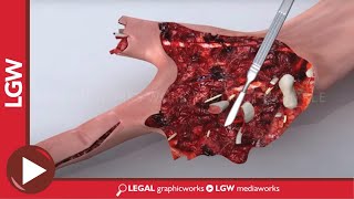 Right Hand Fracture Animated Surgery Recreation [upl. by Ahsocin]