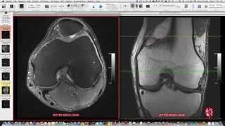 Systematic Interpretation of Knee MRI How I do it [upl. by Charla]